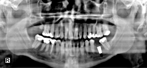 Tissue Equalize Function - After Tissue Equalize Function - After