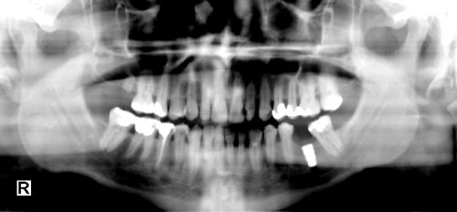 Window Level Function - After Window Level Function - After